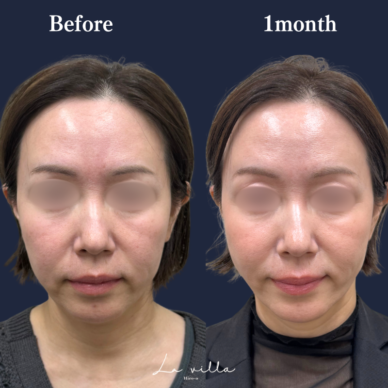 糸リフト+ショッピングリフト No.210