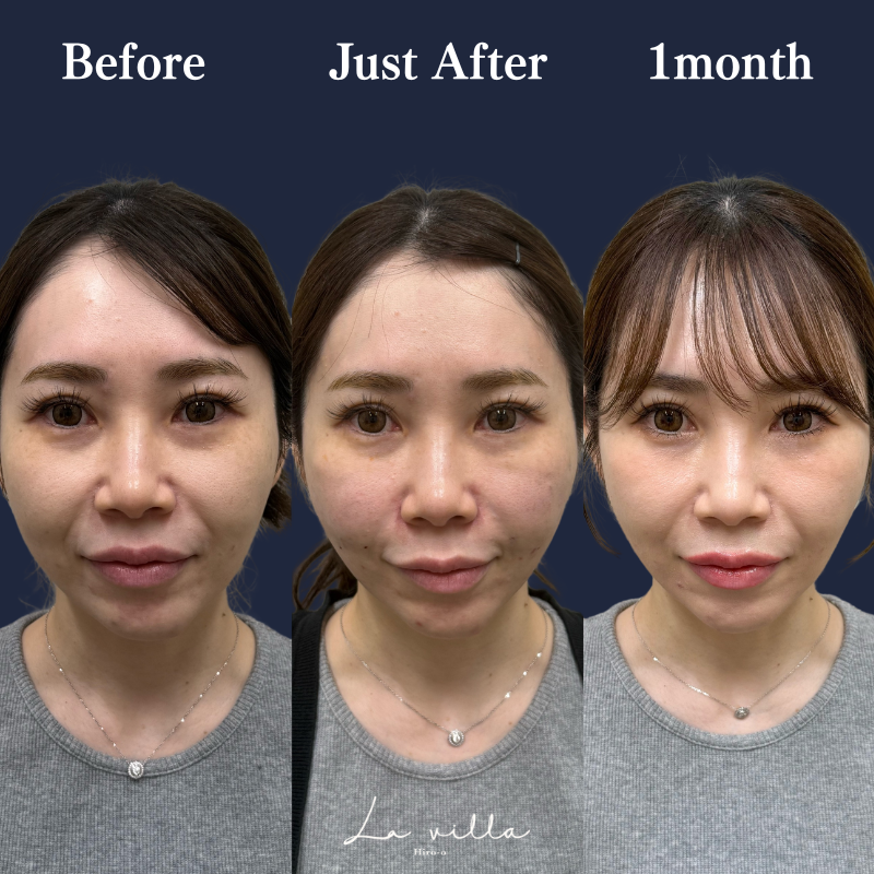 糸リフト+ショッピングリフト No.215