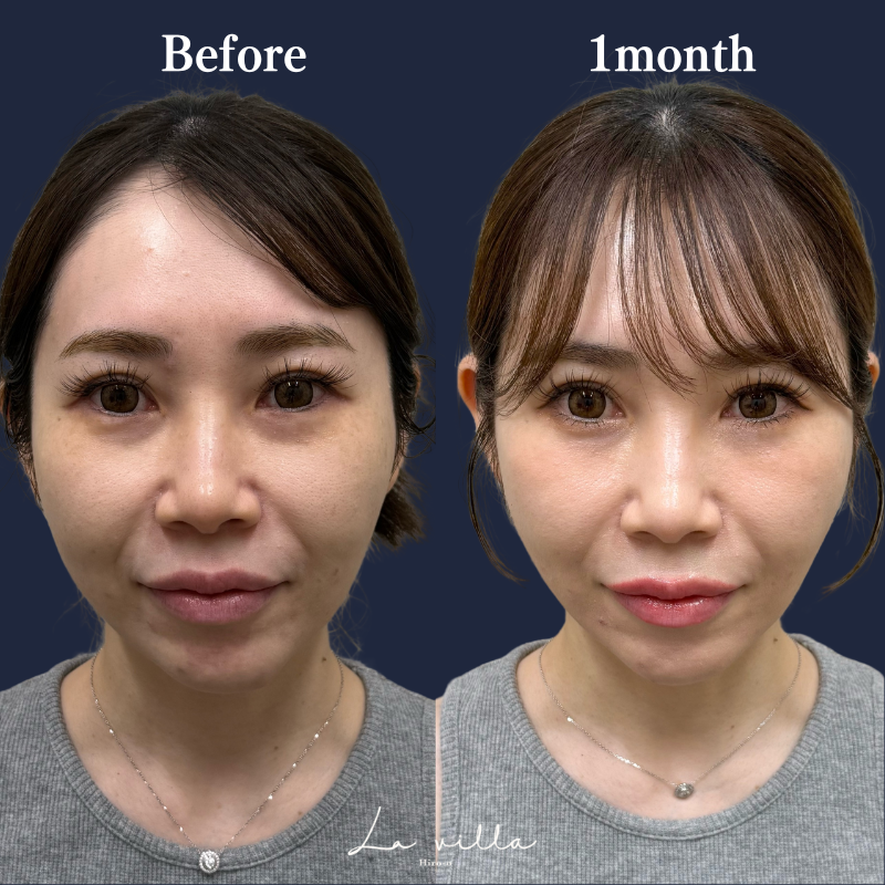 糸リフト+ショッピングリフト No.215