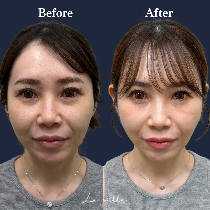 糸リフト+ショッピングリフト No.215