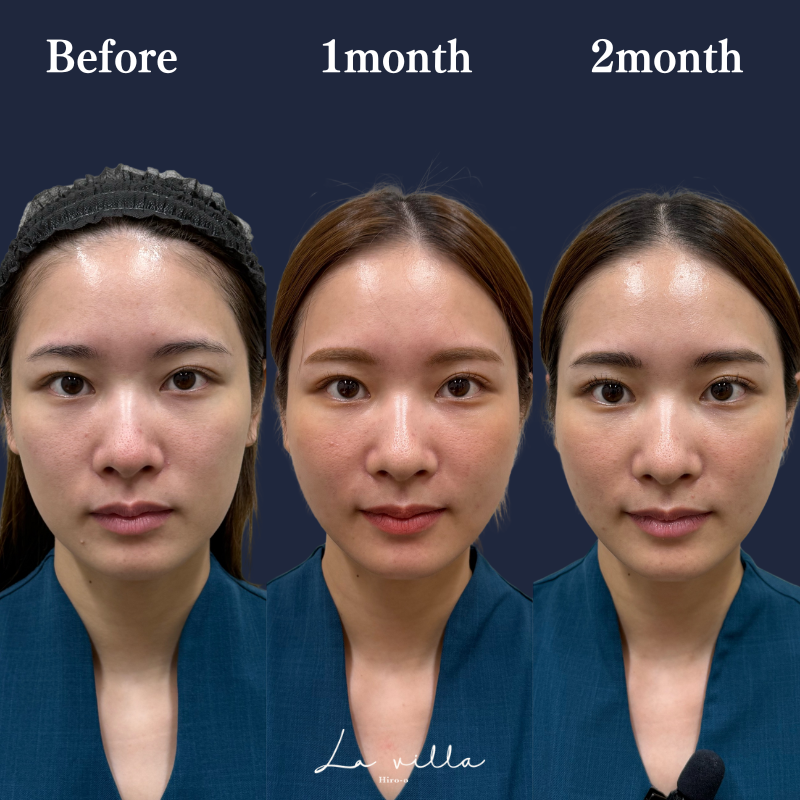 糸リフト+ショッピングリフト No.216