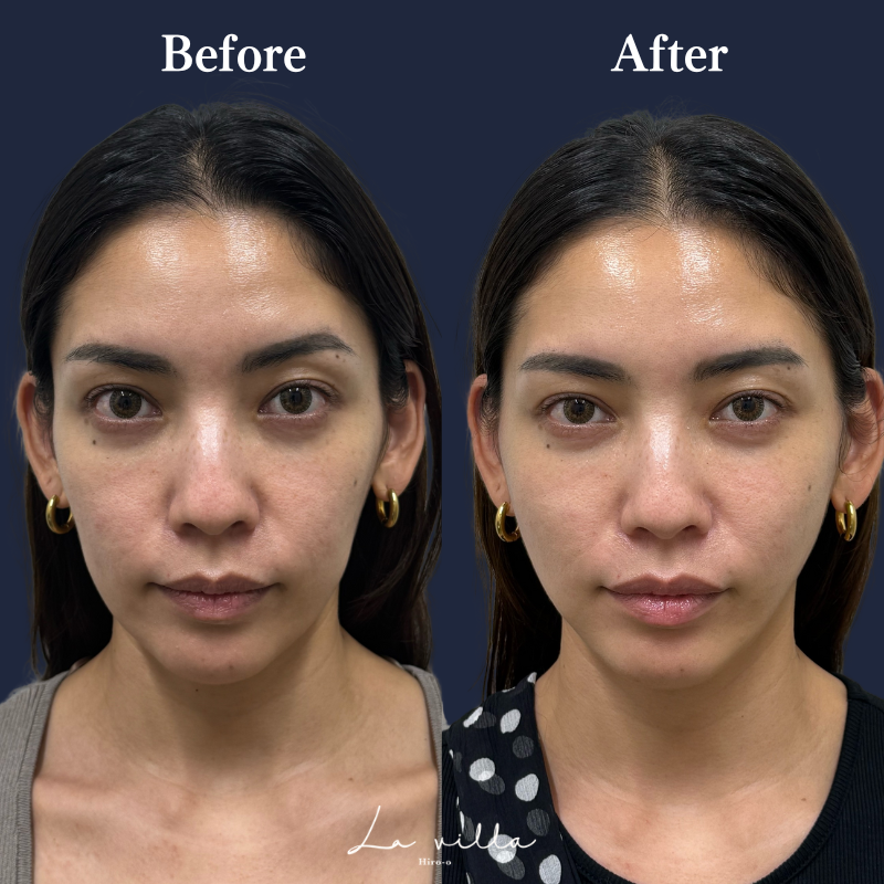 糸リフト+ショッピングリフト No.214