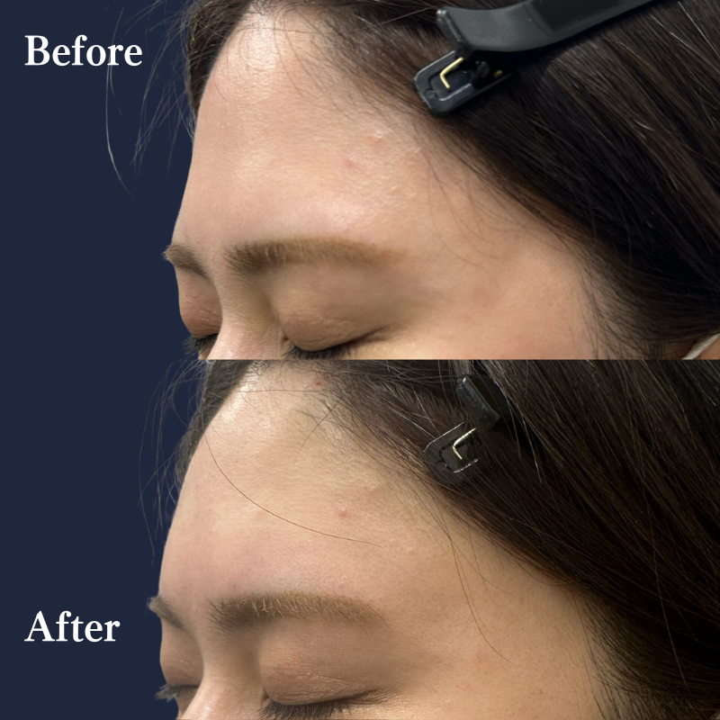 額ヒアルロン酸 No.164