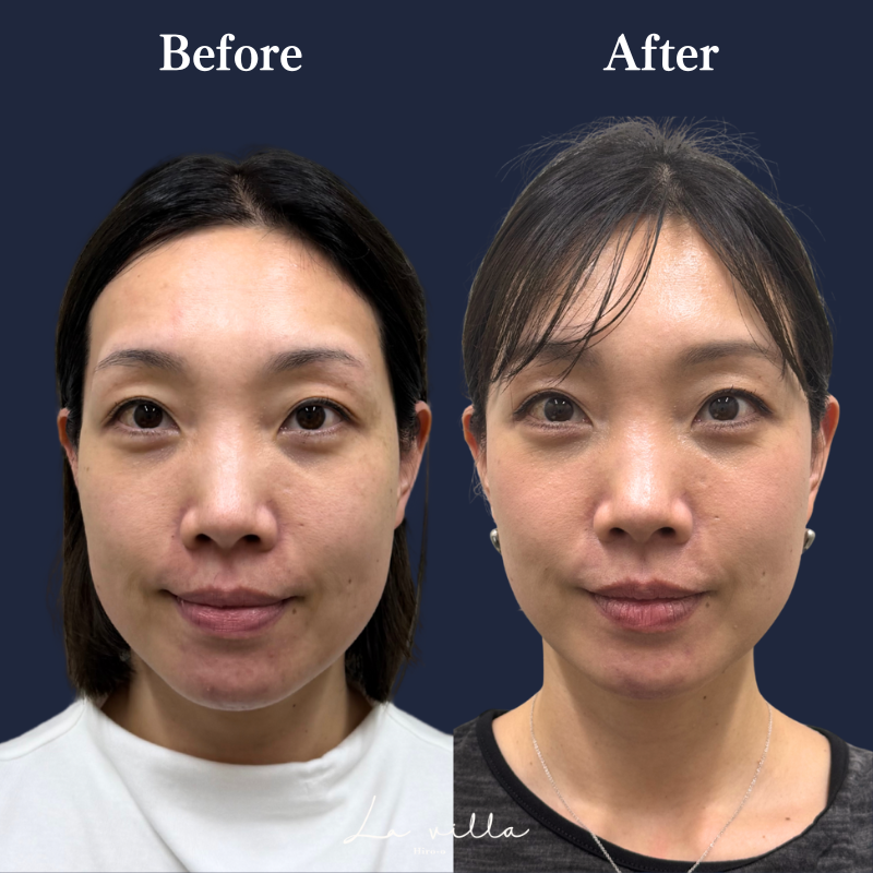 糸リフト+ショッピングリフト No.213