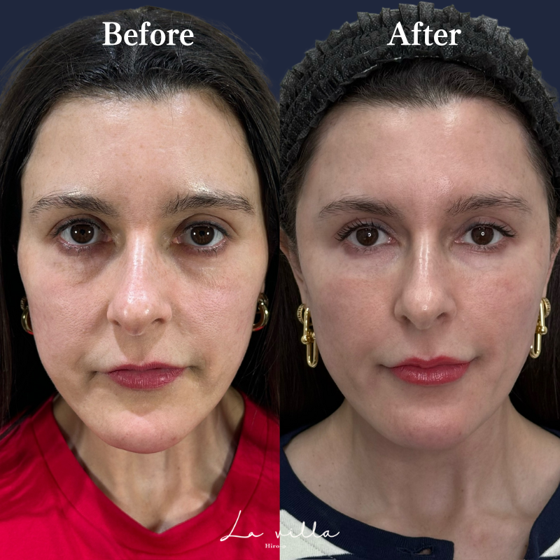 頬・唇・こめかみヒアルロン酸＋全顔ボトックス No.165