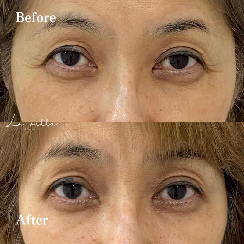 ボトックス（目元・目尻のしわ ）No.170