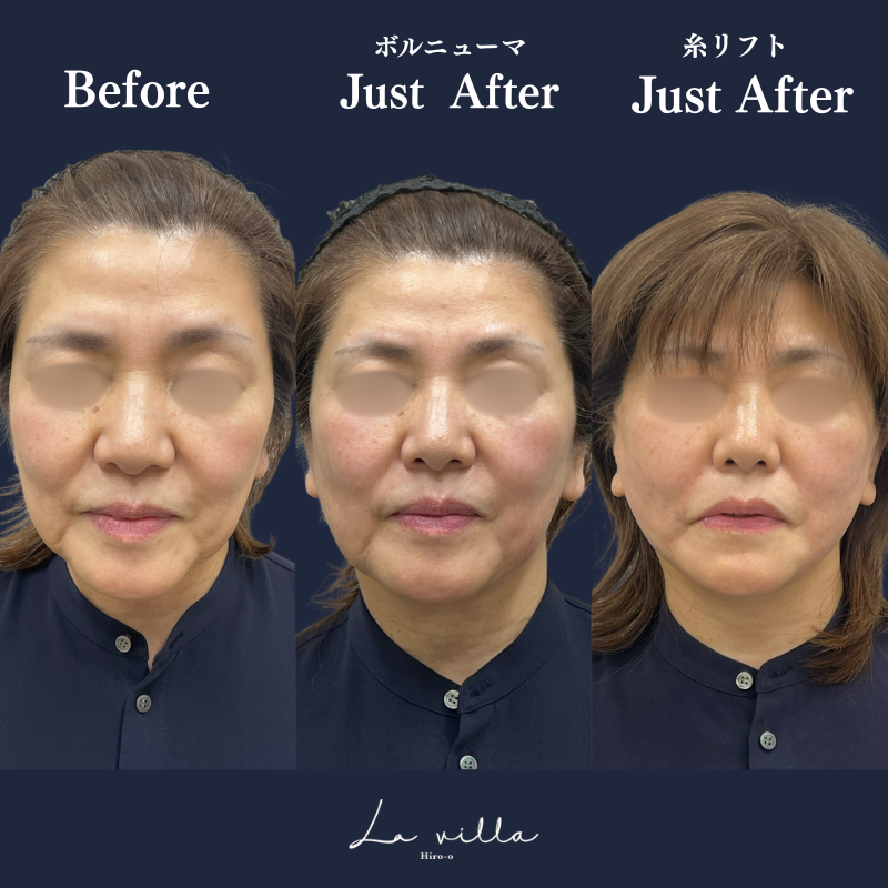 ボルニューマ＋糸リフト　No.177