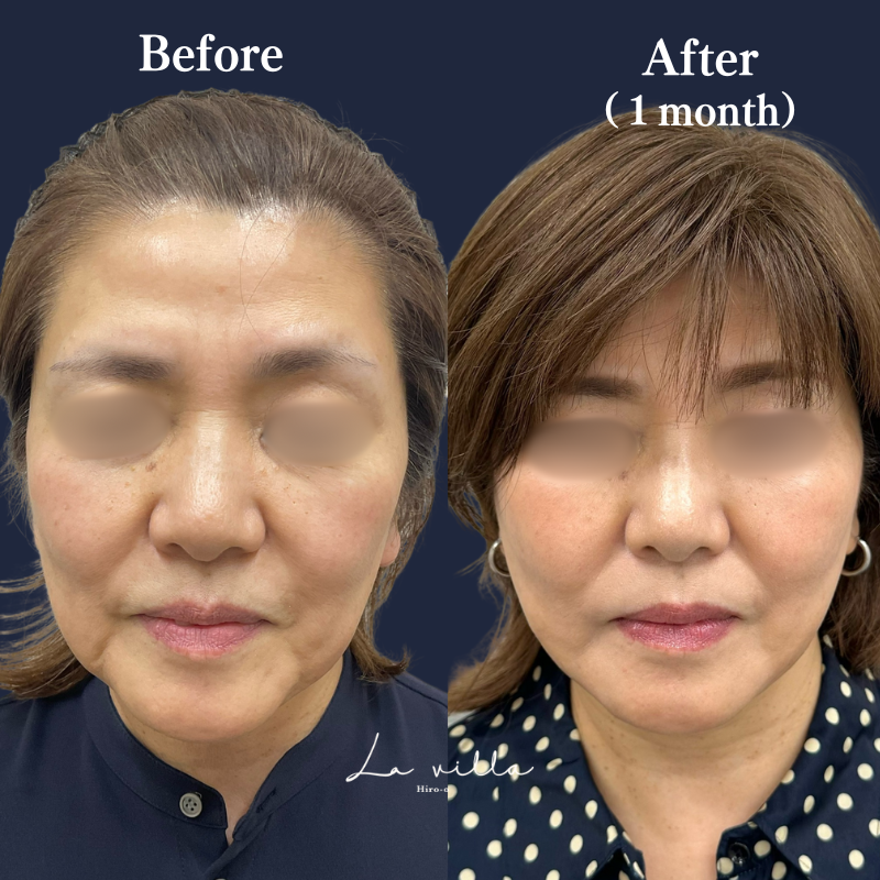 ボルニューマ＋糸リフト　No.177