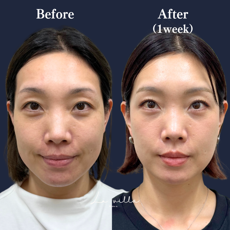 ブレッシング　No.172