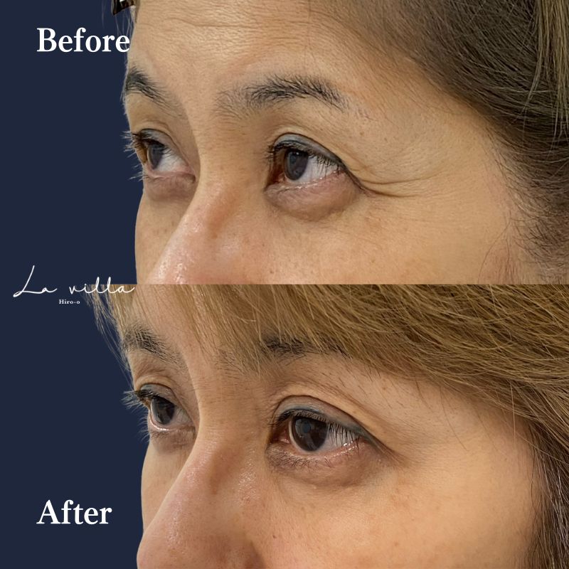 ボトックス（目元・目尻のしわ ）No.170