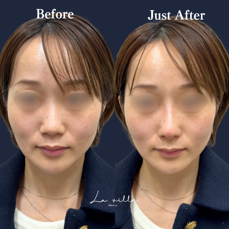 鼻ヒアルロン酸 No.187