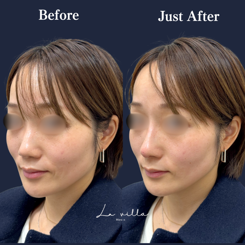 鼻ヒアルロン酸 No.187