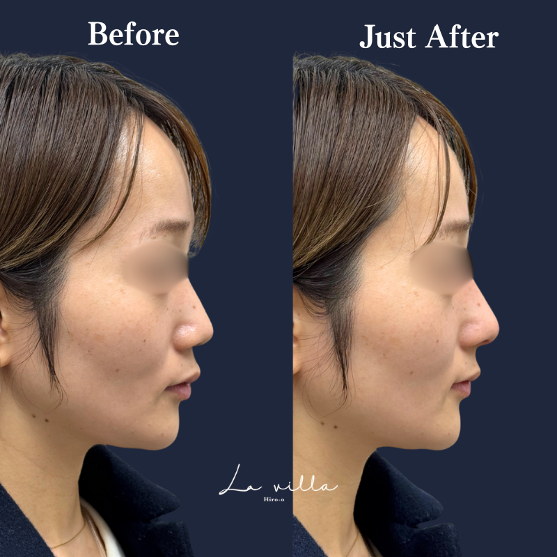 鼻ヒアルロン酸 No.187