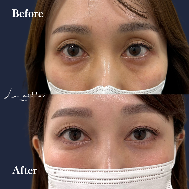 裏ハムラ＋目の上のヒアルロン酸　No.190