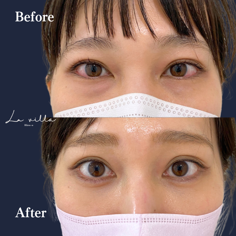 経結膜脱脂+ヒアルロン酸(下眼瞼&涙袋) No.191