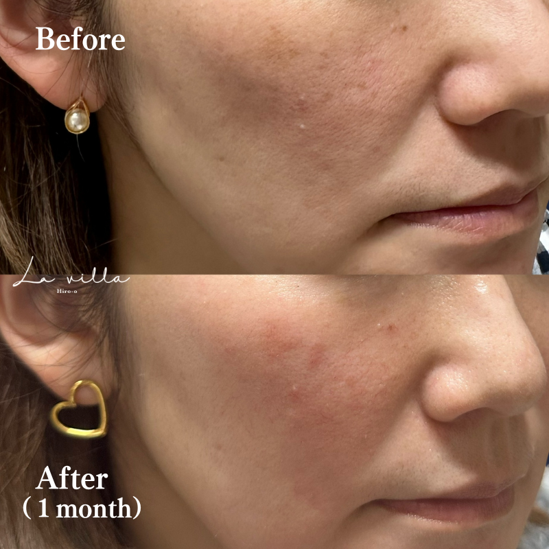 全顔ピコスポット No.176