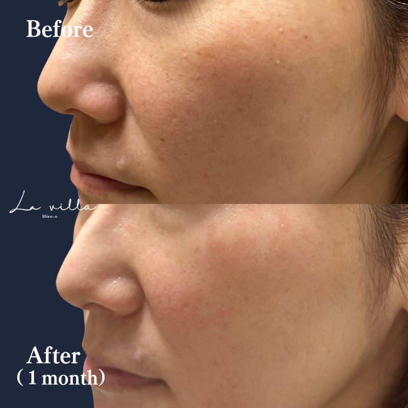 全顔ピコスポット No.176