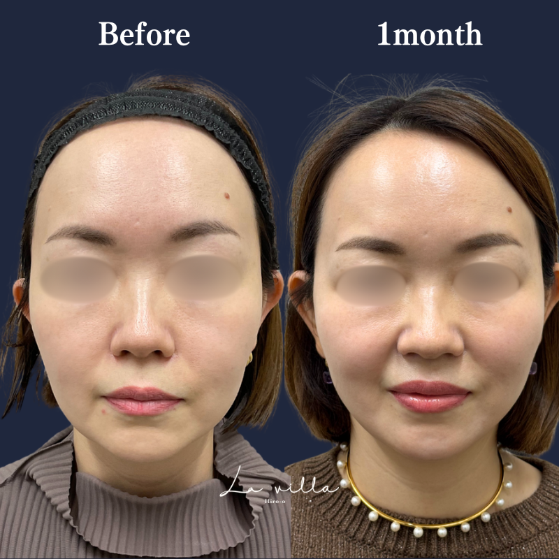 糸リフト＋ショッピングリフト No.234