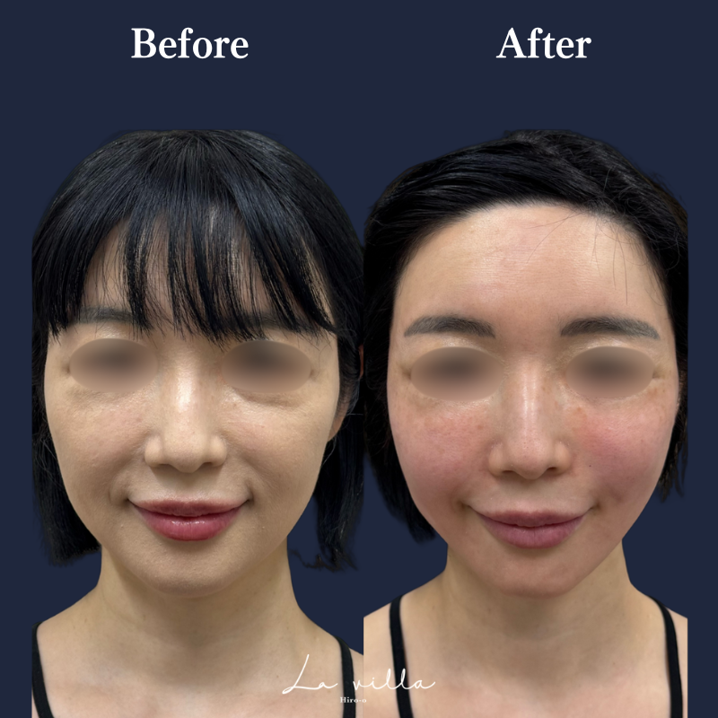 糸リフト+ショッピングリフト No.212