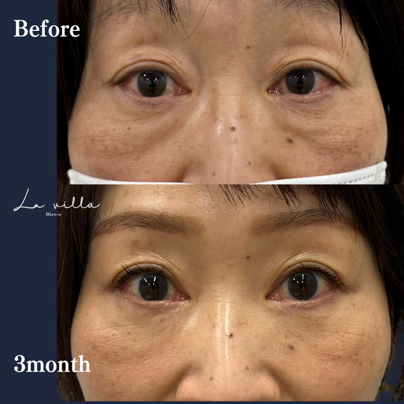 裏ハムラ＋眉下切開 No.194