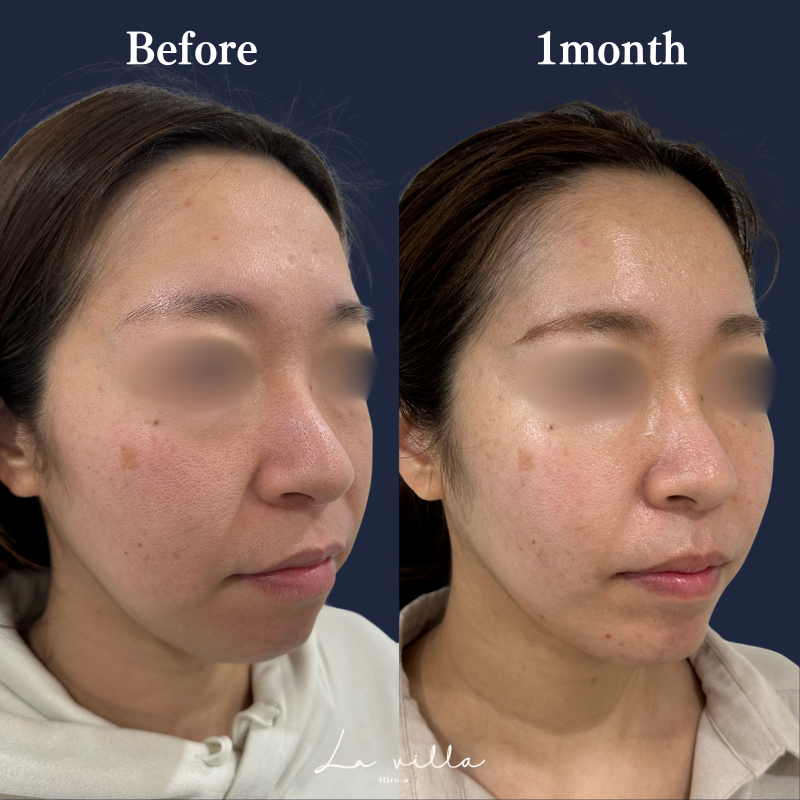 糸リフト+ショッピングリフト No.201