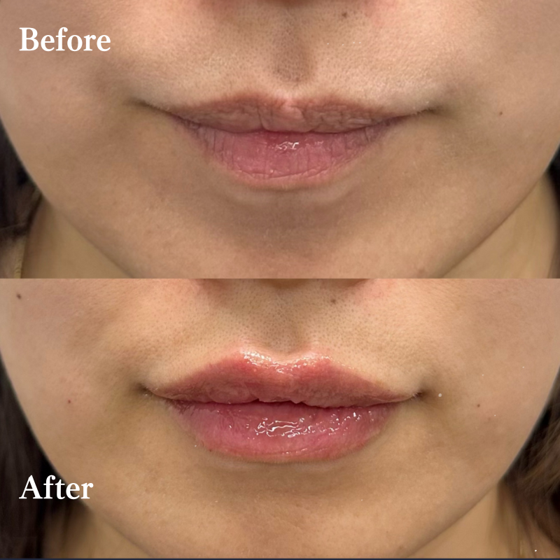 唇ヒアルロン酸  No.150