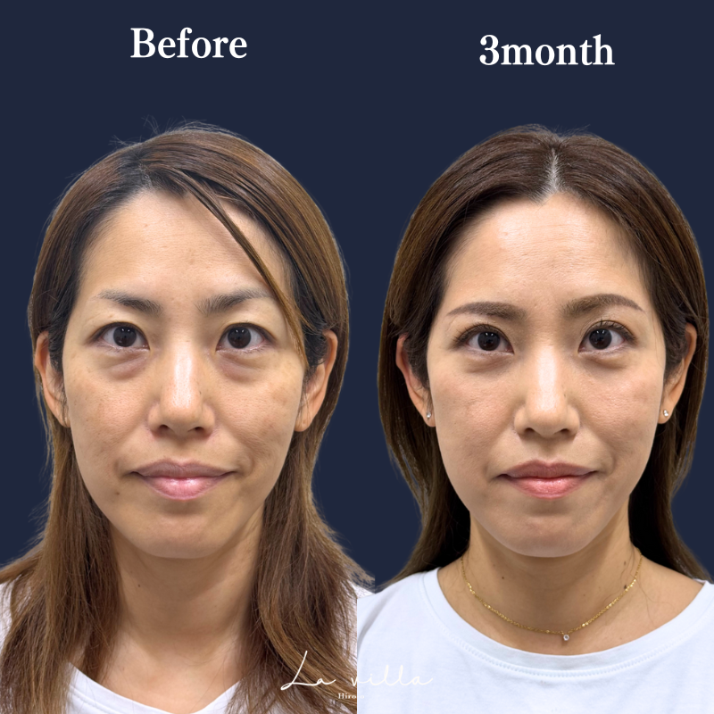 裏ハムラ＋眉下切開 No.218