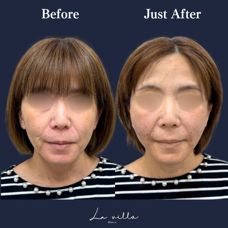 糸リフト＋ショッピングリフト No.161