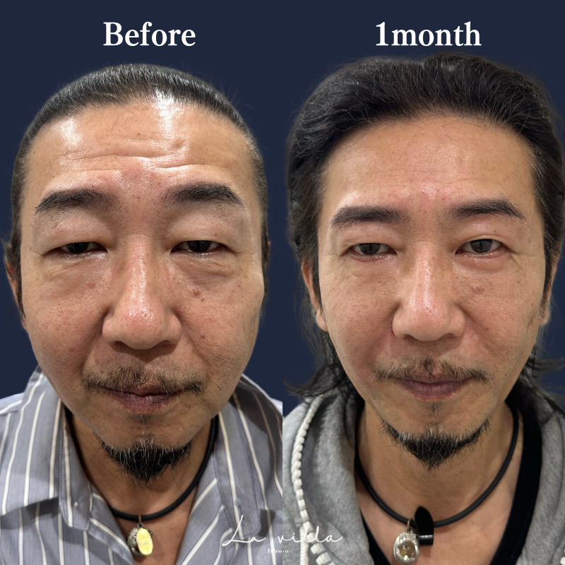 眉下切開＋表ハムラ＋糸リフト＋ショッピングリフト＋額ボトックス No.202