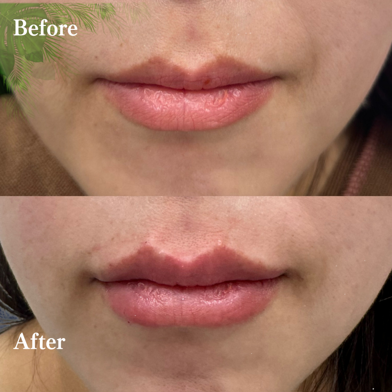 唇ヒアルロン酸  No.149