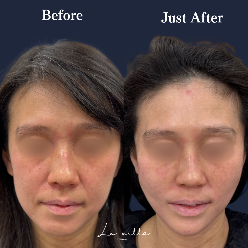 糸リフト＋ヒアルロン酸リフト＋顎ヒアルロン酸 No.229