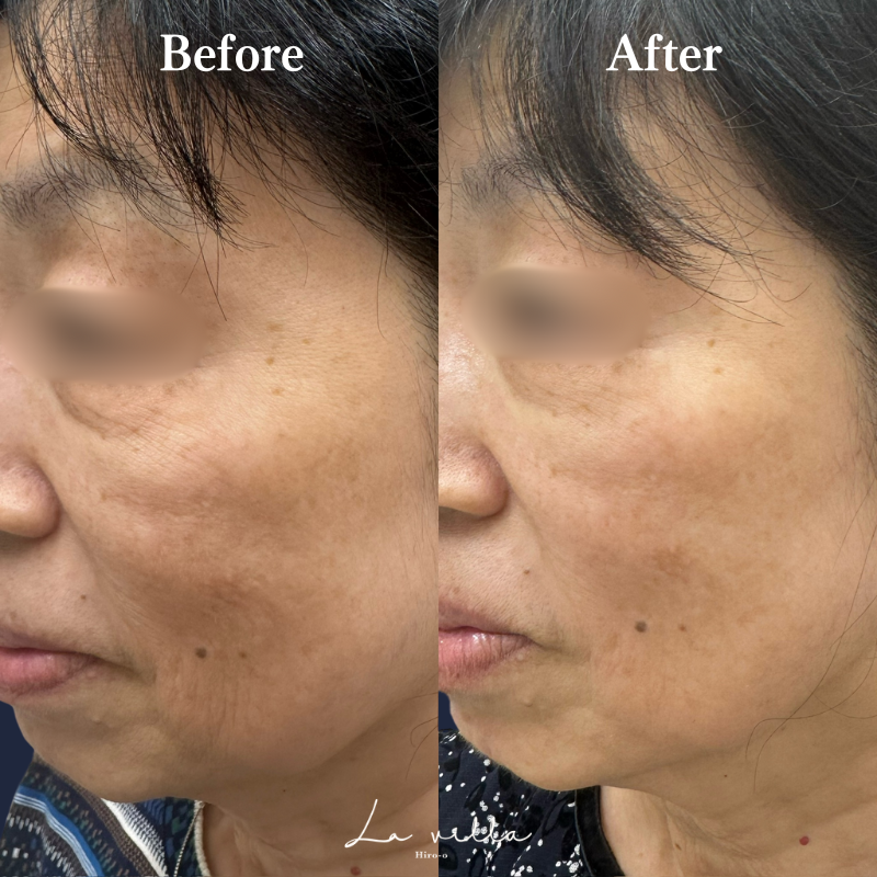 ダーマペン4(ダームエデン) No.211