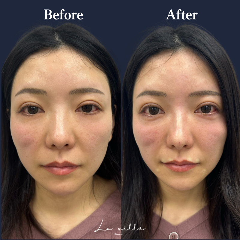 鼻ヒアルロン酸 No.152