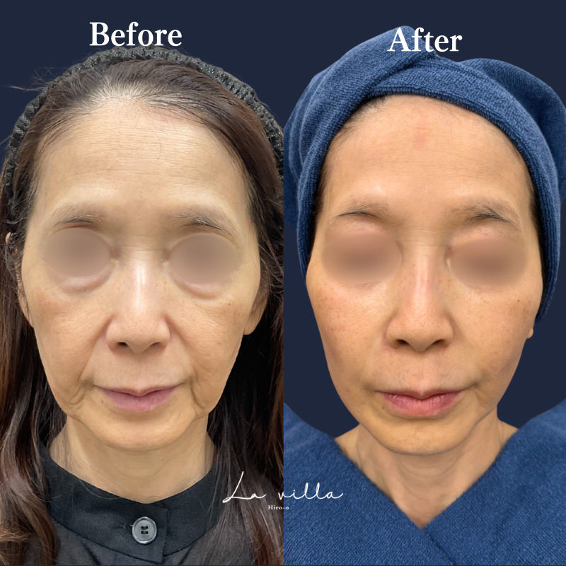 ボルニューマ×リヴァイブ＋ヒアルロン酸リフト＋ジャルプロスーパーハイドロ No.198