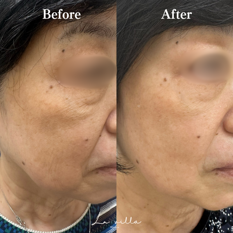 ダーマペン4(ダームエデン) No.211