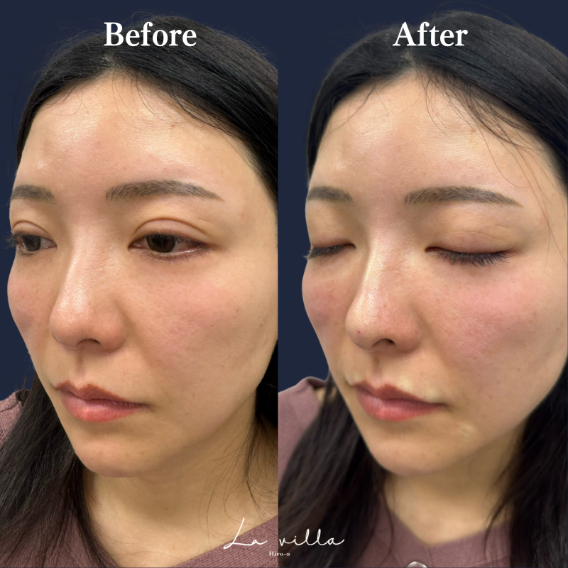 鼻ヒアルロン酸 No.152