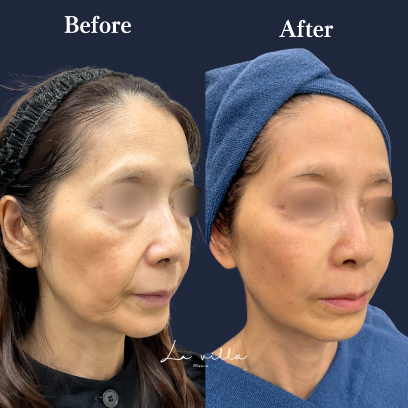 ボルニューマ×リヴァイブ＋ヒアルロン酸リフト＋ジャルプロスーパーハイドロ No.198