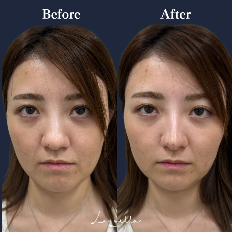 鼻ヒアルロン酸 No.153