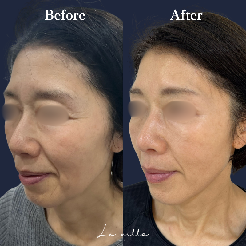 糸リフト＋ショッピングリフト+全顔ボトックス　No.162