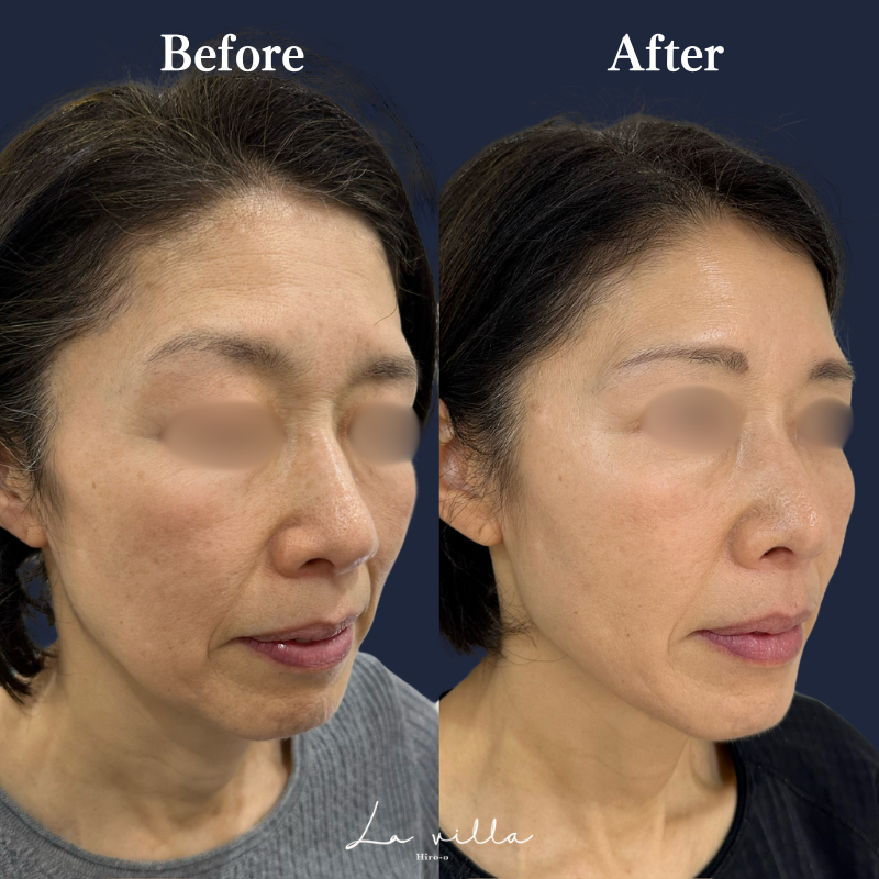 糸リフト＋ショッピングリフト+全顔ボトックス　No.162