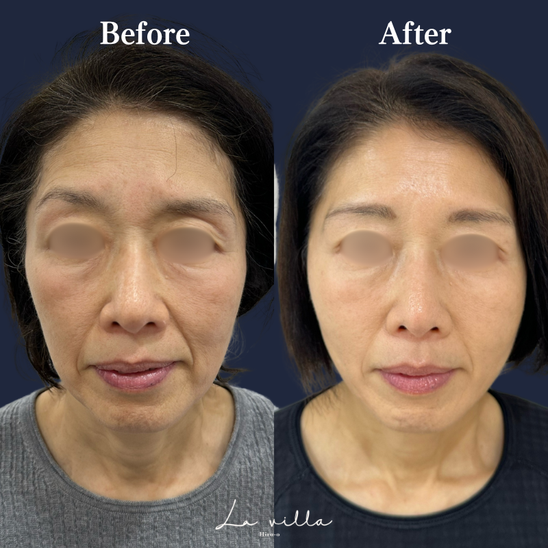 糸リフト＋ショッピングリフト+全顔ボトックス　No.162