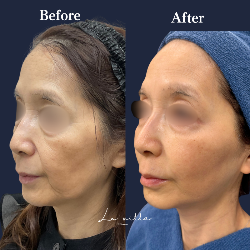 ボルニューマ×リヴァイブ＋ヒアルロン酸リフト＋ジャルプロスーパーハイドロ No.198