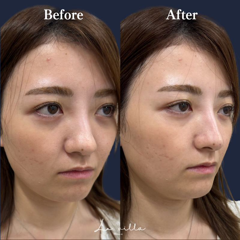 鼻ヒアルロン酸 No.153