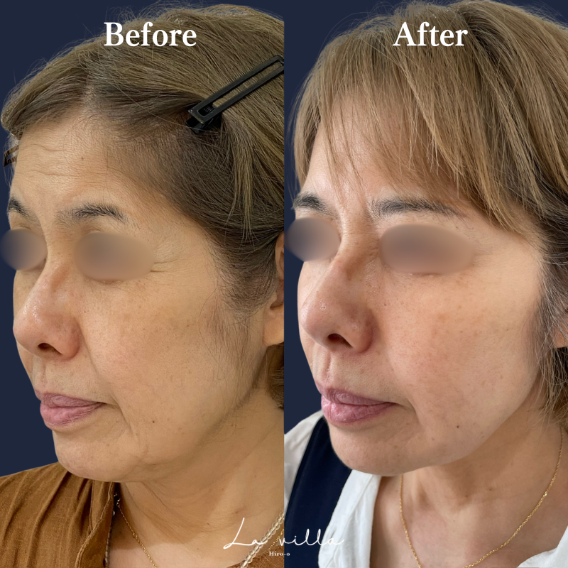 糸リフト＋SL＋全顔ボトックス＋広頚筋ボトックス　No.163