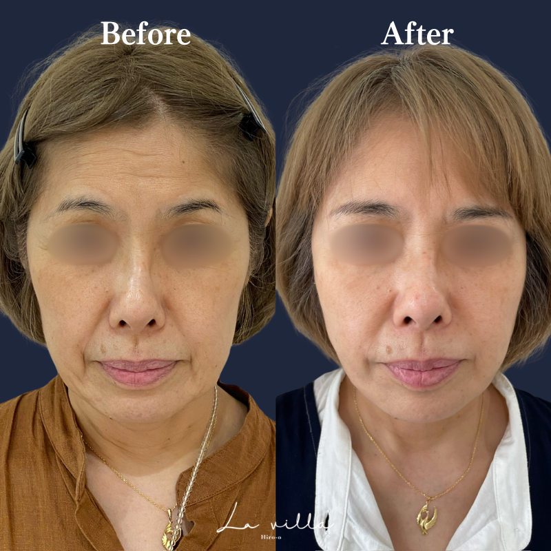 糸リフト＋SL＋全顔ボトックス＋広頚筋ボトックス　No.163