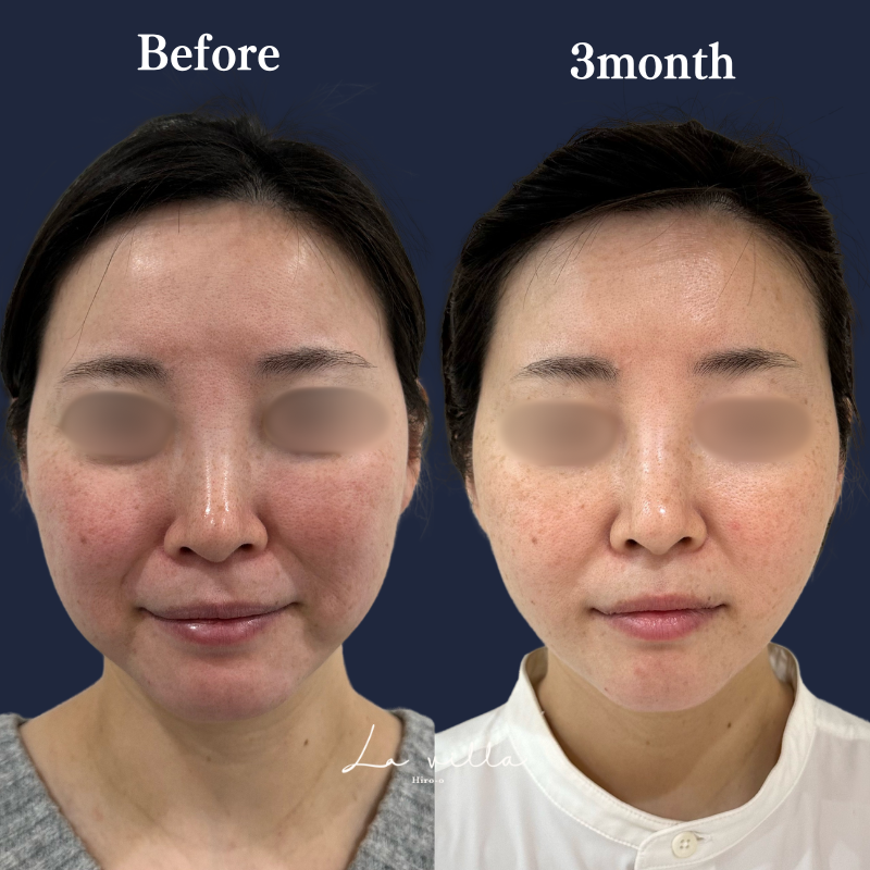 糸リフト+ショッピングリフト+頬の脂肪吸引 No.199