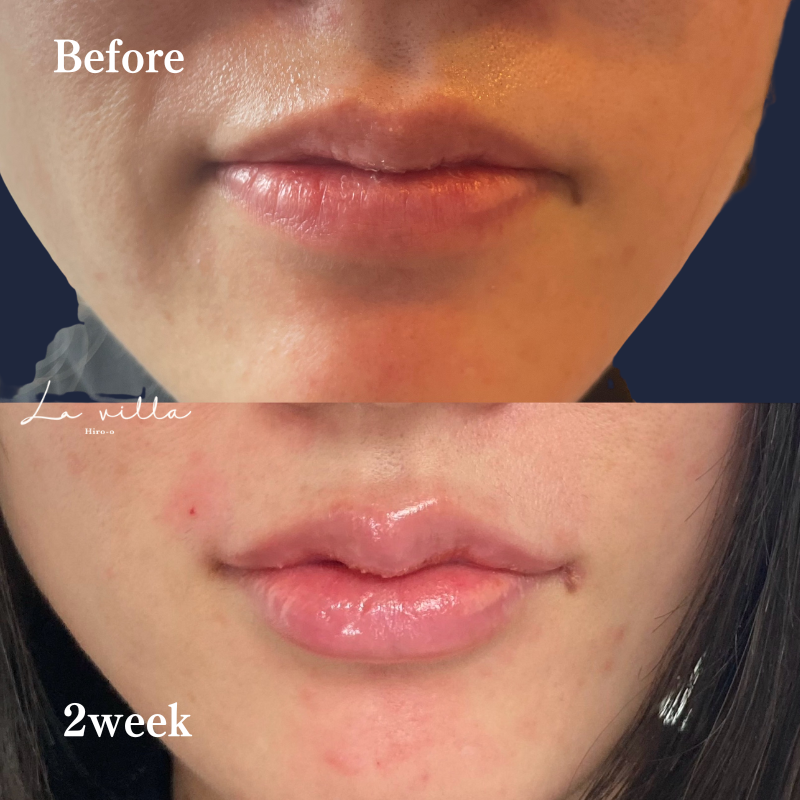 唇ヒアルロン酸  No.203