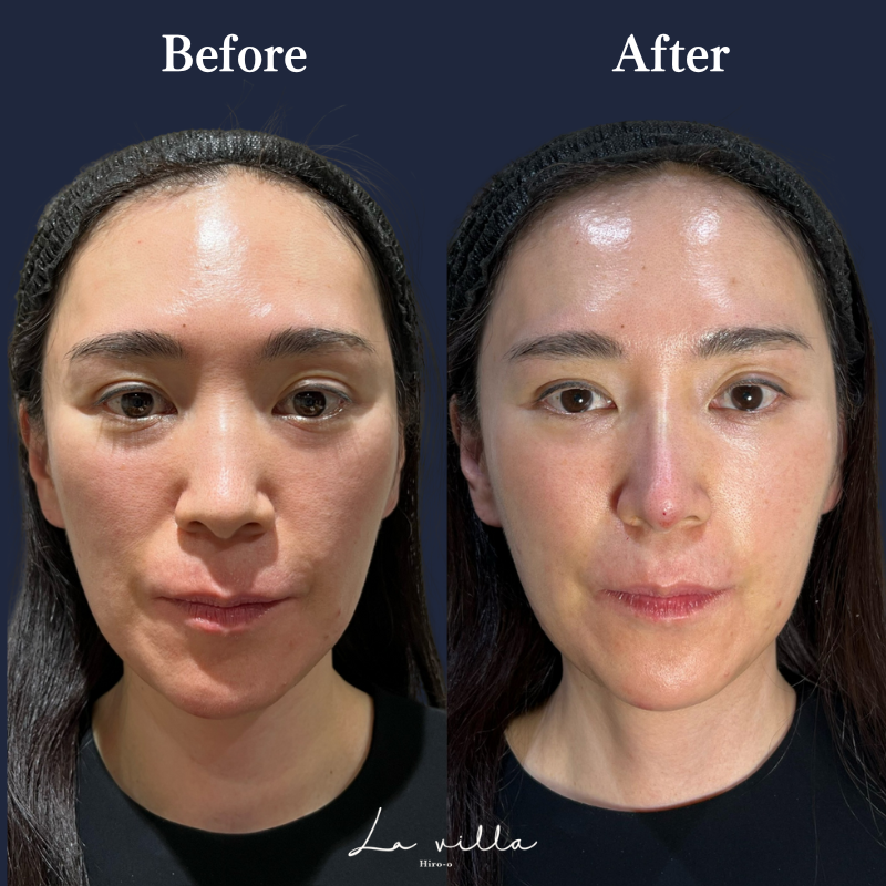 鼻ヒアルロン酸 No.154