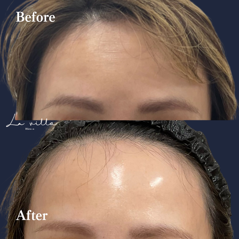 額ボトックス No.169