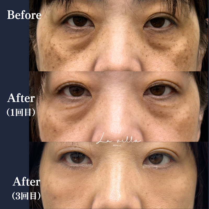 ピコトーニング+リバースピール No.242